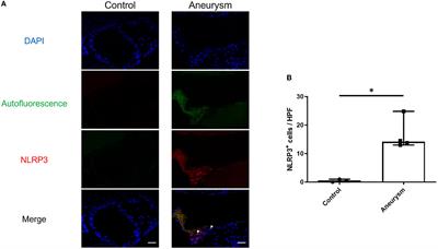 NLRP3 inflammasome inhibition protects against intracranial aneurysm rupture and alters the phenotype of infiltrating macrophages